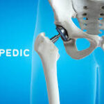Choosing the Best Orthopedics in USA